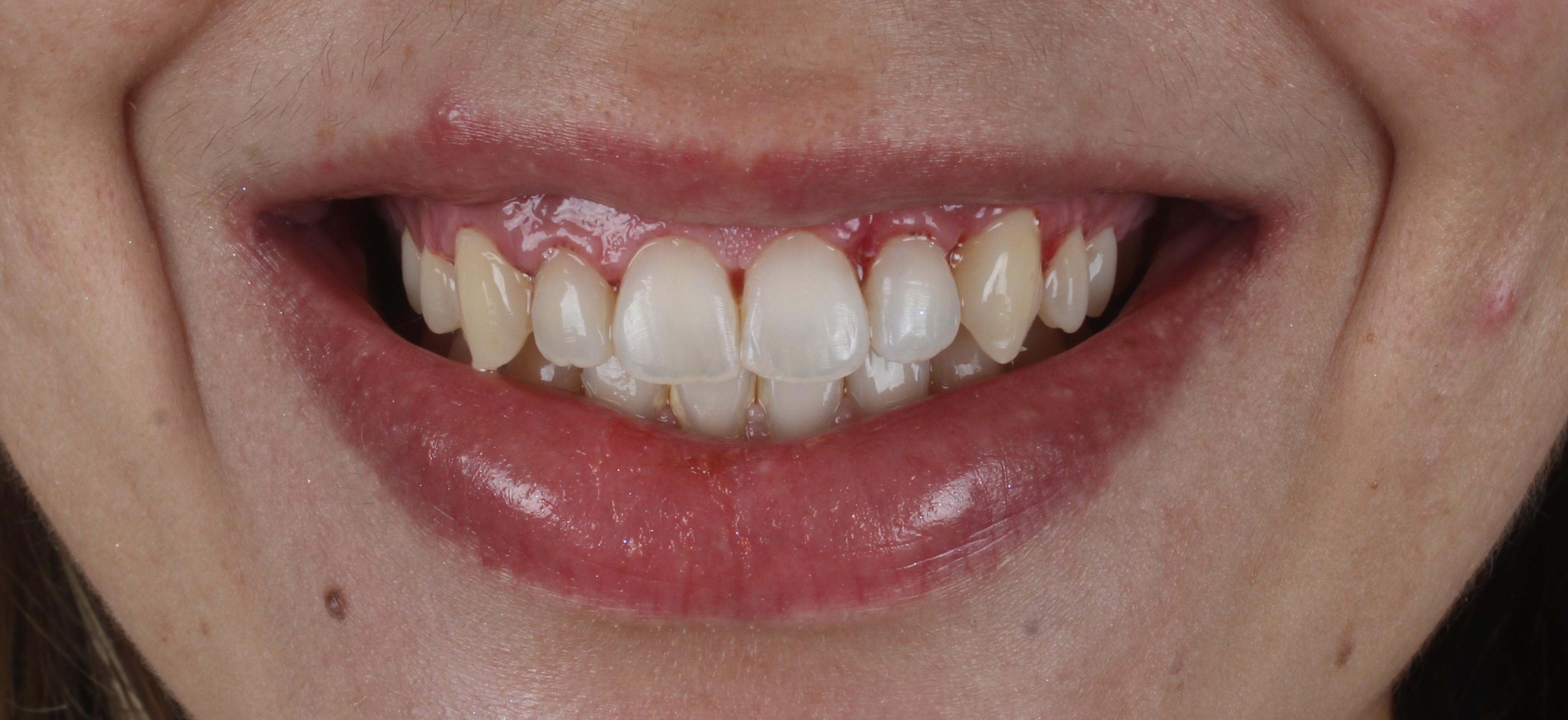 Depois da gengivoplastia